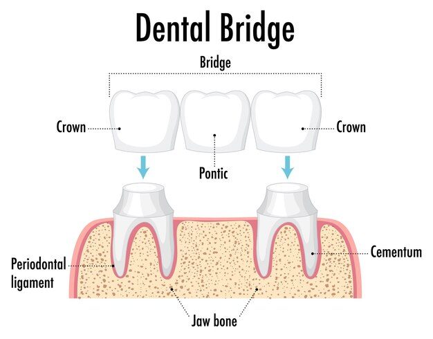 zirconia crown bridge